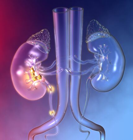 3d medically illustration showing kidney stones in minor and major calyces and ureter Stock Photo