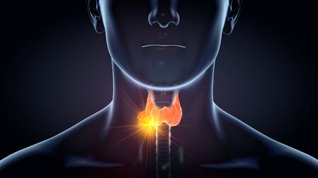 Medically 3d illustration showing thyroid cancer of a man, medically illustration on black background