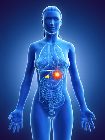 3d rendered medically accurate illustration of a womans adrenal glands cancer Stock Photo