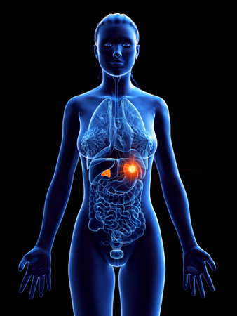 3d rendered medically accurate illustration of a womans adrenal glands cancer