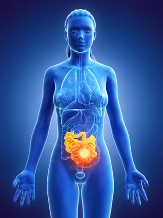 3d rendered medically accurate illustration of a womans small intestine cancer Stock Photo