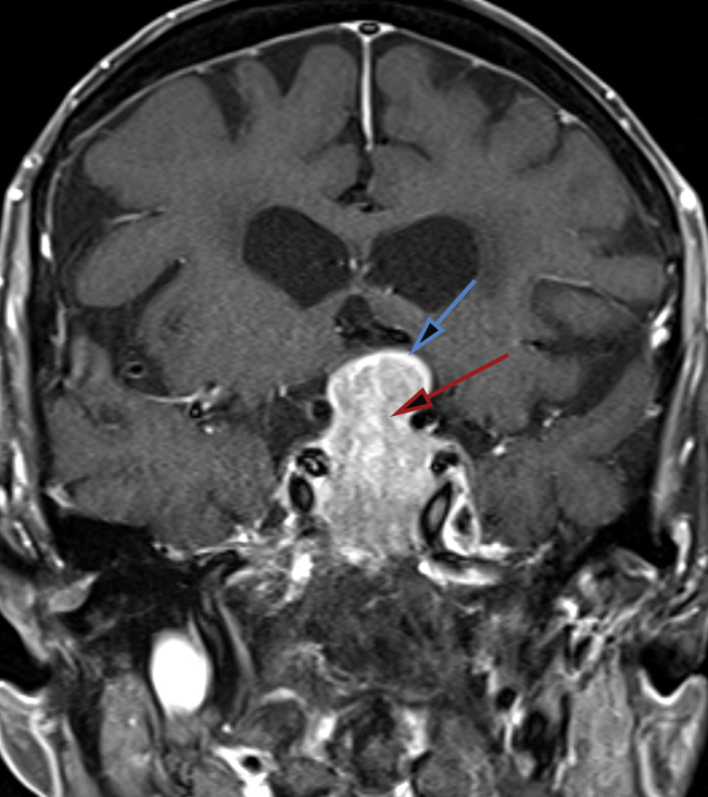  Figure 2. The top image demonstrates a coronal MRI with contrast. The pituitary microadenoma (red arrow) is pushing the compressed rim of normal gland up (blue arrow.) The bottom image shows a coronal MRI with contrast of a pituitary macroadenoma; the tumor (red arrow) is pushing the rim of pituitary gland up as well. Note the difference in the size of microadenomas and macroadenomas. 