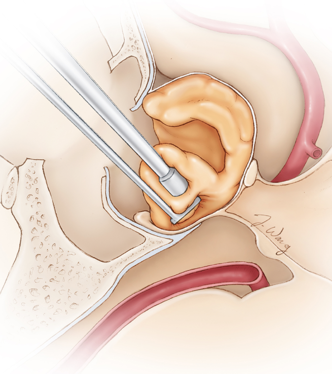  Figure 3. In this side view or sagittal illustration of the surgical corridor, the pituitary tumor (orange) is removed via surgical instruments that are passed through the nose. This procedure is called transnasal transsphenoidal surgery and is very effective in removal of such tumors. 