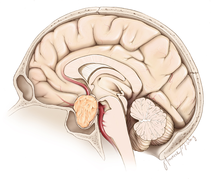  Figure 1. A pituitary tumor (orange) is demonstrated in coronal (front view) and sagittal (side view) planes of the head. A thin rim of the normal gland is usually draped over the tumor. 